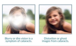 Cataracts in diabetes