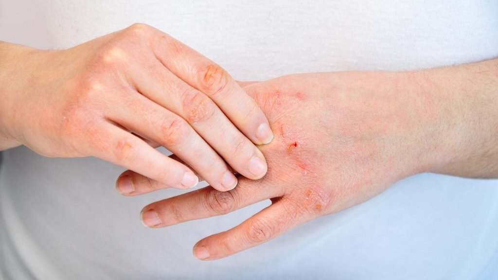 Atopic Dermatitis (Eczema)